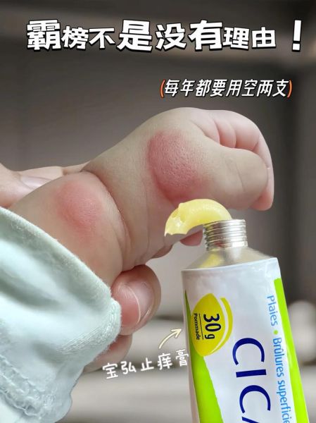 宝宝手被蚊子咬肿了怎么办_婴儿蚊虫叮咬快速消肿方法