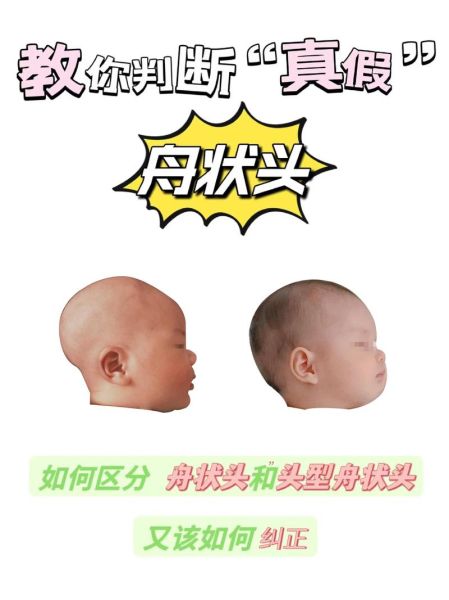 宝宝舟状头型图片_舟状头几个月定型
