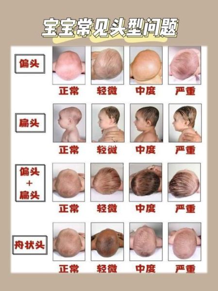 宝宝舟状头型图片_舟状头几个月定型