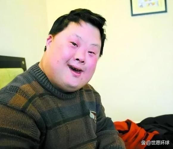 唐氏宝宝能活多久_唐氏宝宝有哪些特征