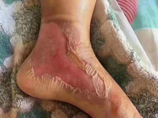 宝宝烫伤破皮会留疤吗_如何正确护理不留疤