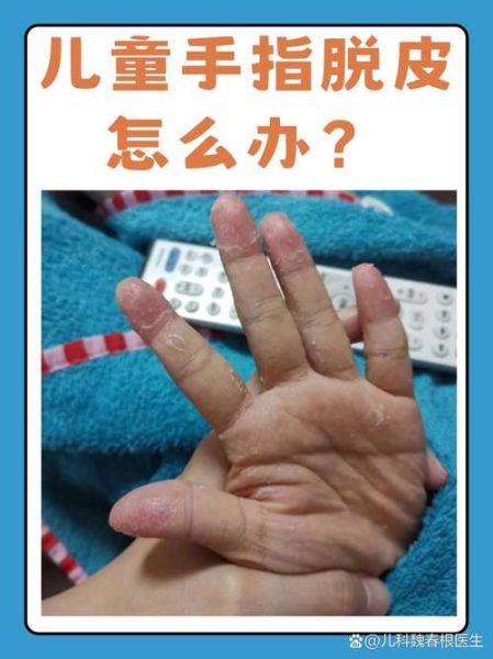3岁宝宝手指脱皮是怎么回事_宝宝手指脱皮怎么办