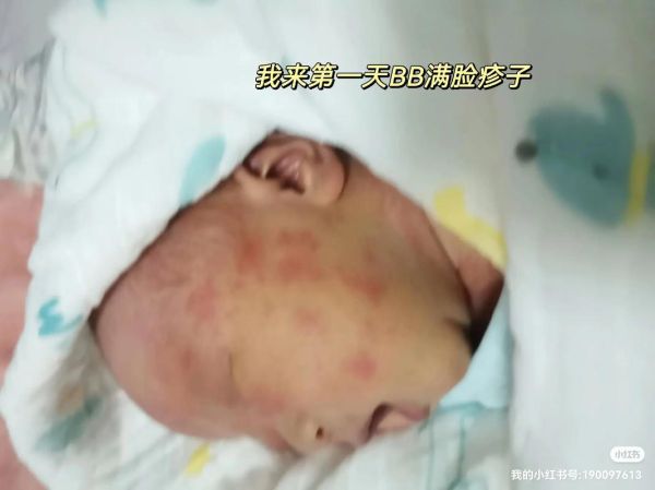 8个月宝宝起疹子怎么办_宝宝反复出疹子如何护理