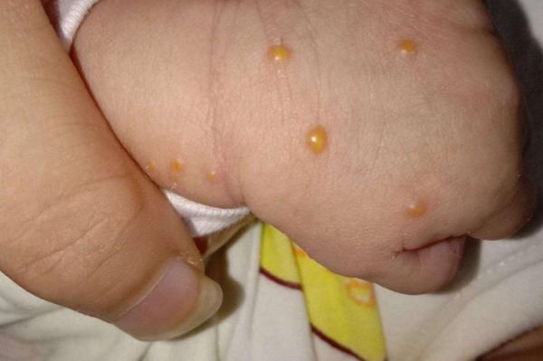 宝宝水痘早期症状图片_水痘初期红点照片