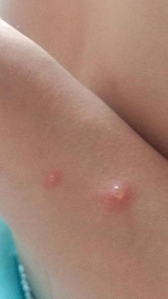 宝宝水痘早期症状图片_水痘初期红点照片