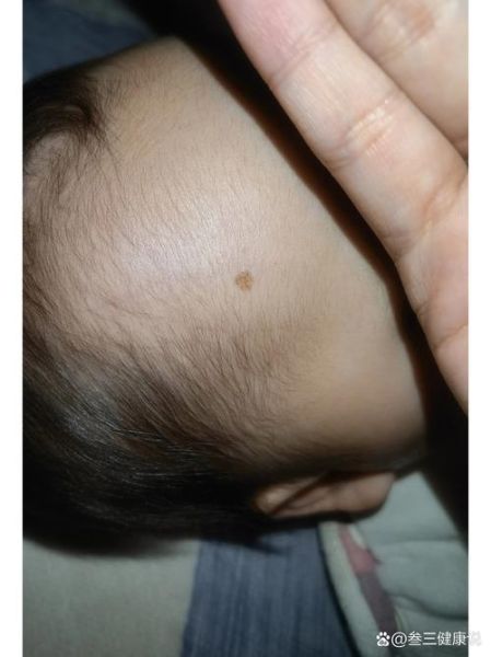 宝宝黑色素痣会癌变吗_什么时候必须切除