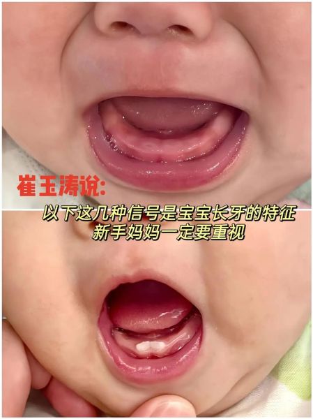 宝宝几个月开始长牙_长牙晚正常吗