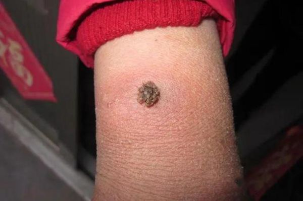 瘊子图片大全_瘊子初期症状图片