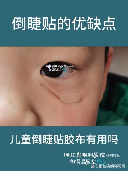 宝宝倒睫毛怎么处理_婴儿倒睫会自愈吗