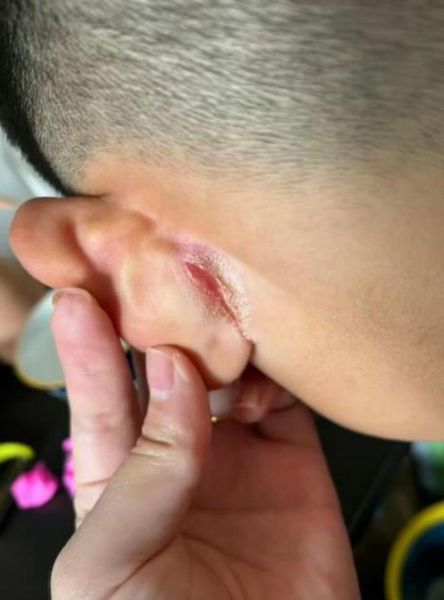 宝宝耳垂下边裂口怎么办_婴儿耳垂裂口护理方法