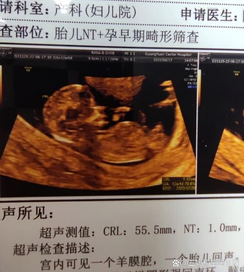 鼻骨缺失生下宝宝照片_胎儿鼻骨缺失能要吗