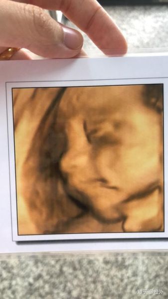 鼻骨缺失生下宝宝照片_胎儿鼻骨缺失能要吗