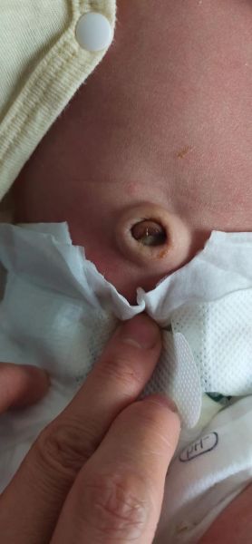 宝宝十天了脐带还没掉_脐带脱落延迟怎么办