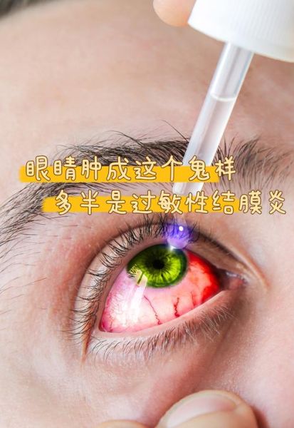 宝宝早上起床眼睛肿怎么回事_宝宝眼睛肿怎么快速消肿