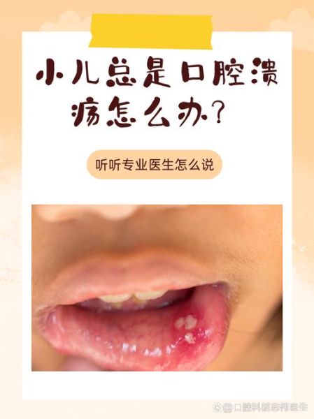 宝宝喉咙溃疡图片_喉咙溃疡怎么办