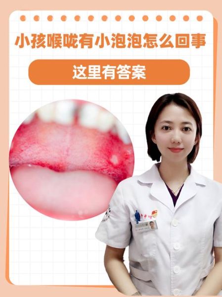 宝宝喉咙溃疡图片_喉咙溃疡怎么办