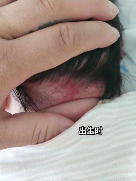 宝宝发丹的症状图片_宝宝发丹初期图片