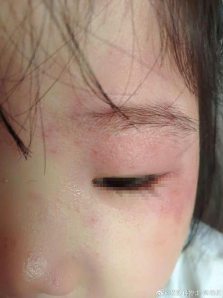 宝宝发丹的症状图片_宝宝发丹初期图片