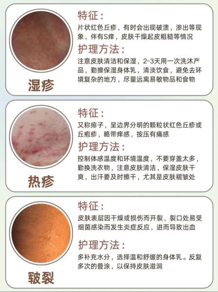 宝宝湿疹反复怎么办_湿疹反复的原因