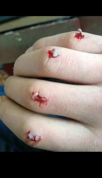 梦到自己受伤流血_是什么意思