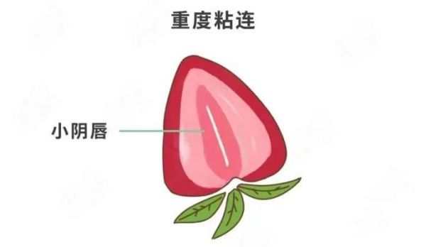 宝宝小阴粘连看什么科_小阴唇粘连挂哪个科室