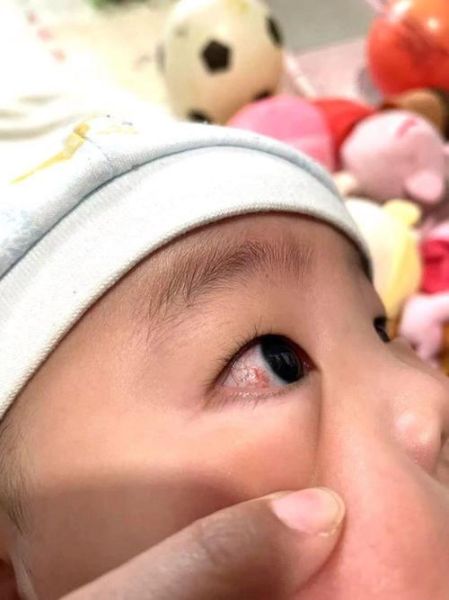 6个月宝宝眼睛有红血丝_怎么办