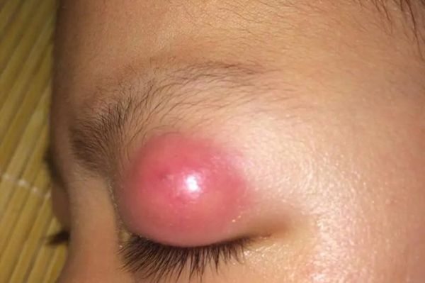 宝宝眼皮上长了个小疙瘩是怎么回事_需要看医生吗