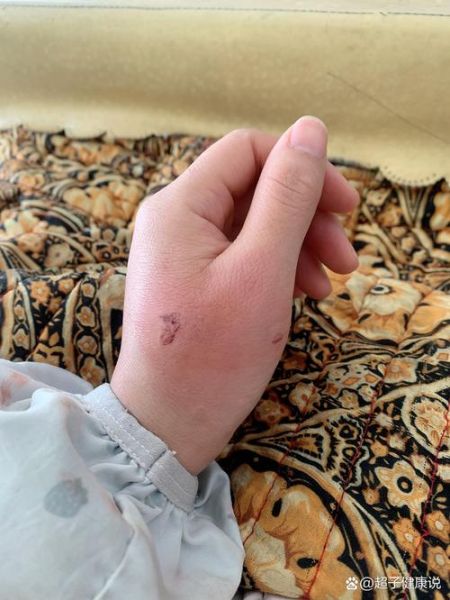 梦到被猫咬是什么意思_被猫咬出血预示什么