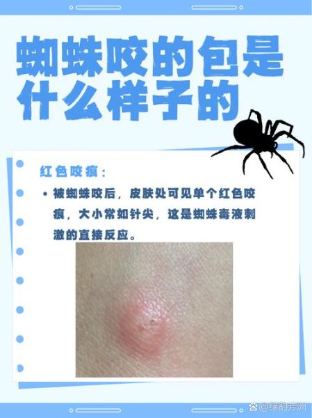 梦到被蜘蛛咬是什么意思_被蜘蛛咬预示什么