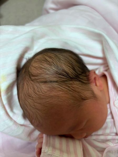 宝宝头皮血肿多久能消_需要抽吸吗