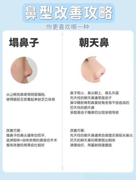 鼻子类型图解_塌鼻梁怎么改善