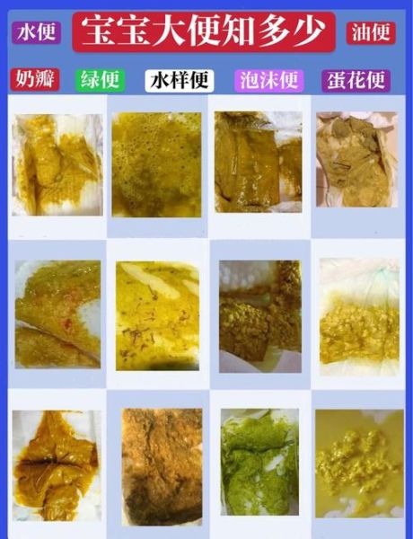 肠套叠宝宝大便图片_果酱样便是唯一信号吗