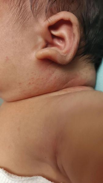 宝宝湿疹多久能好_婴儿湿疹一般几个月消退