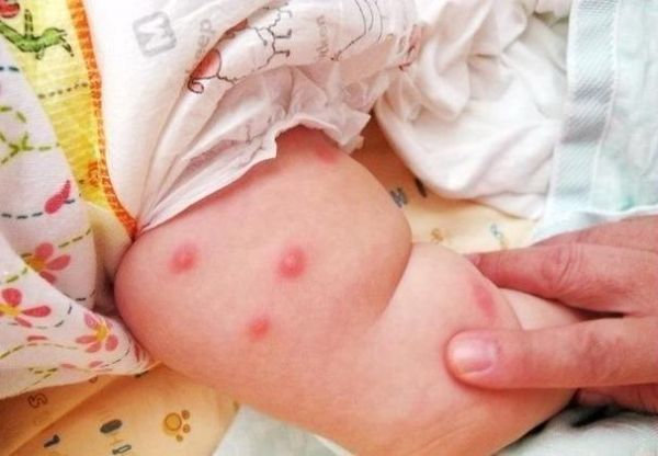 宝宝湿疹多久能好_婴儿湿疹一般几个月消退