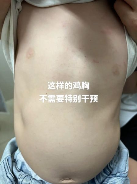 宝宝鸡胸早期症状图片_如何辨别
