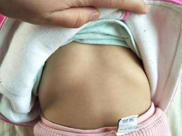 宝宝鸡胸早期症状图片_如何辨别