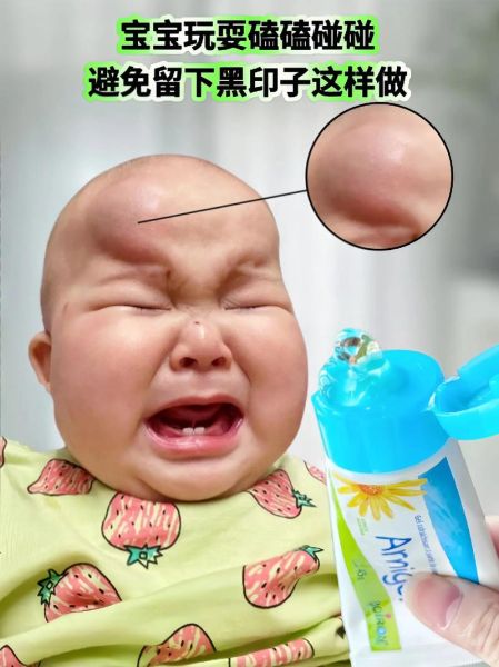 宝宝头上摔了个大包怎么消肿_多久能消