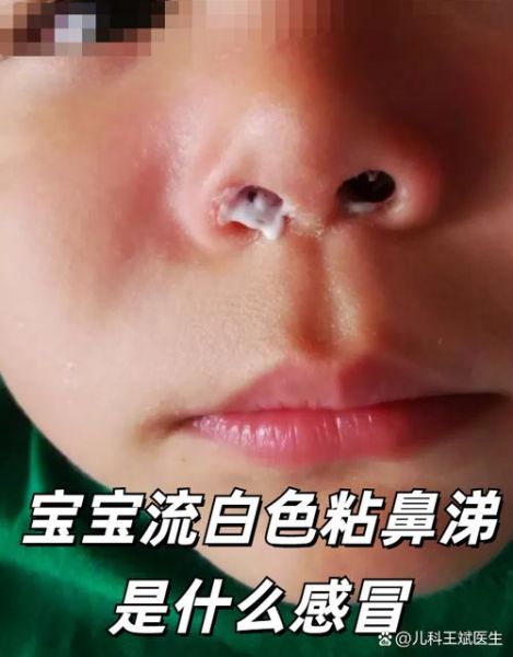 宝宝流白色粘鼻涕怎么办_白色粘鼻涕是感冒吗