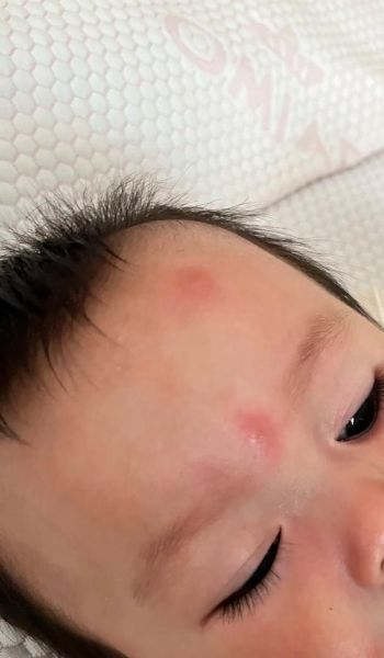 宝宝蚊虫叮咬过敏怎么办_宝宝被蚊子咬了红肿很大怎么办