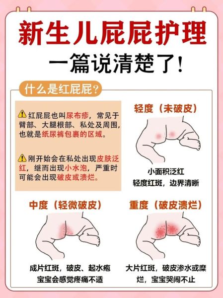 宝宝红屁股怎么处理_红屁股最快最有效的办法