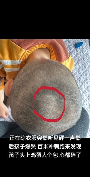 一岁宝宝磕到后脑勺怎么办_会不会脑震荡