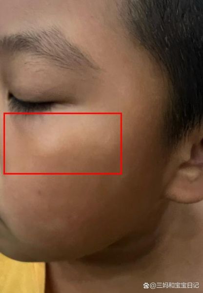 宝宝脸上白块是什么_需要看医生吗