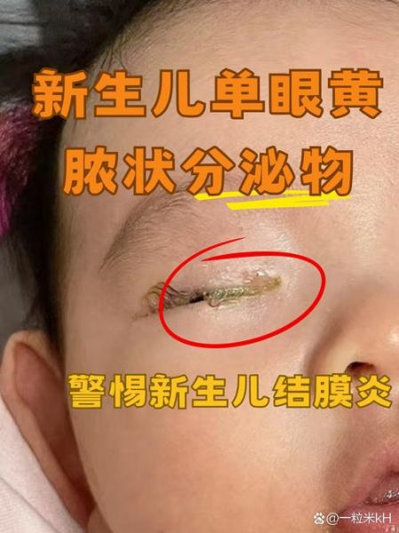 宝宝眼睛往上翻白眼是怎么回事_新生儿翻白眼正常吗