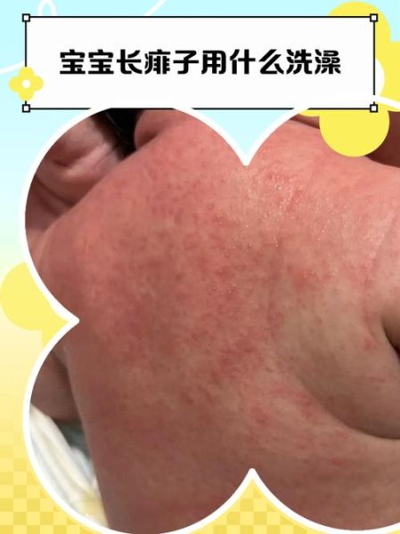 宝宝痱子图片_怎么快速消退
