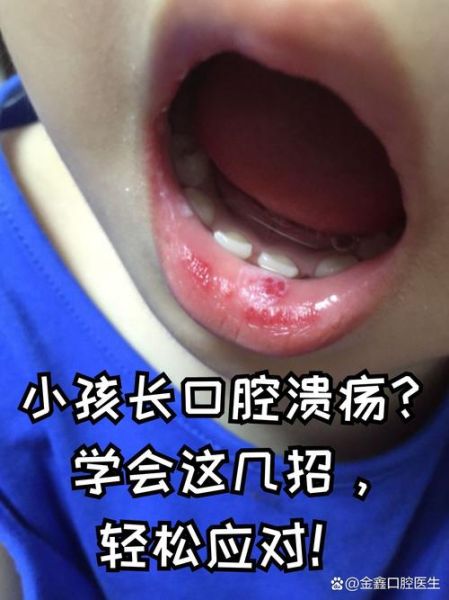 宝宝嘴巴里长溃疡怎么办_婴儿口腔溃疡快速止痛