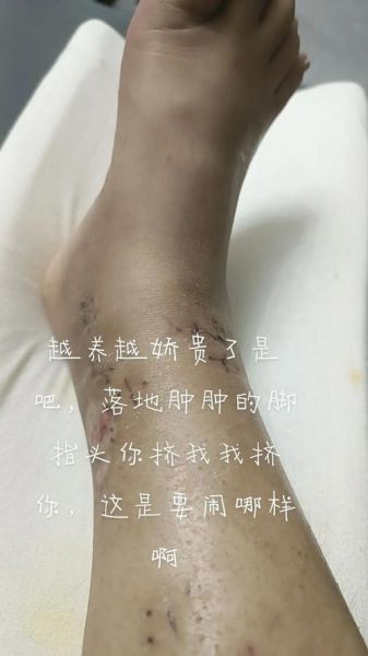 梦到骨折是什么意思_梦见骨折预示什么