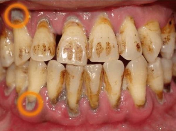 牙齿图片大全图_如何辨别龋齿与牙结石