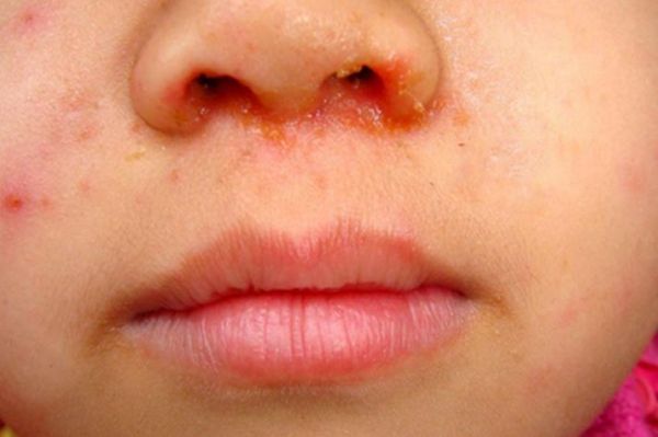 宝宝鼻子里面红肿怎么办_宝宝鼻黏膜红肿多久能好