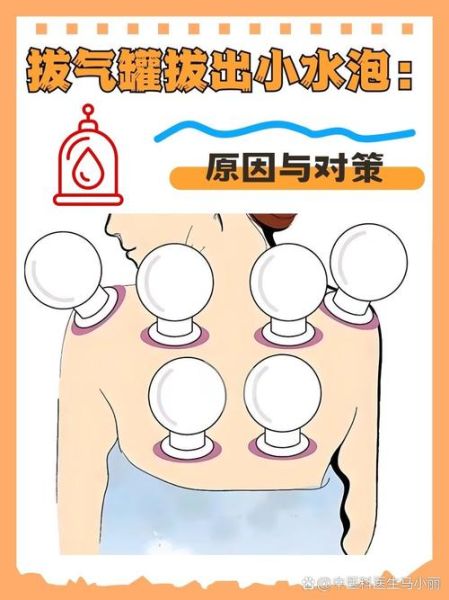 一岁宝宝能不能拔气罐_婴儿拔气罐安全吗