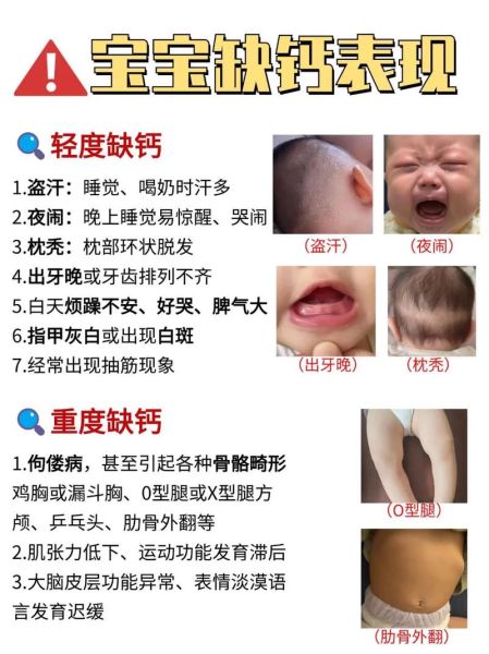 宝宝缺钙有哪些症状_怎么判断婴儿是否缺钙
